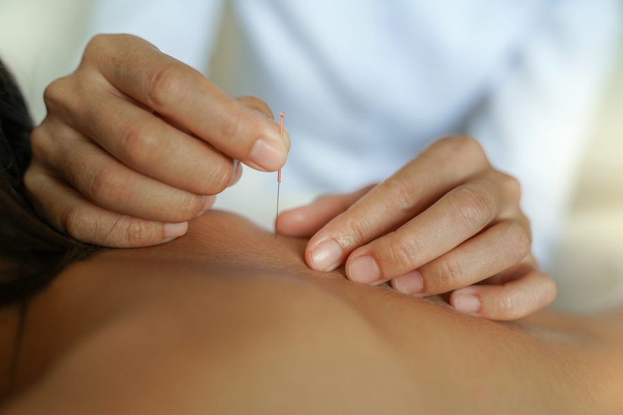 Dry Needling Rotterdam — BDD Fysiotherapie